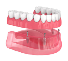 Implant Supported Denture